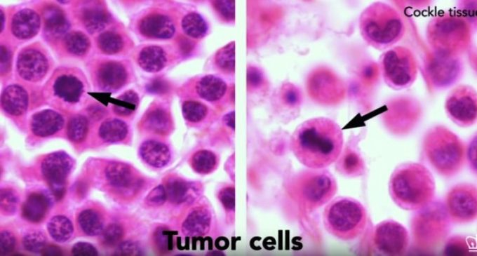 Il Cancro può essere contagioso e trasmesso come una “normale infezione”
